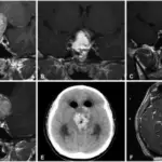 Effects of Local Mass Effects on the Pituitary Gland