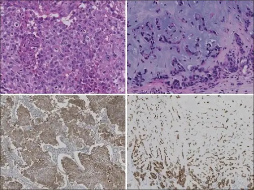 Embryonal Carcinoma of the Ovary