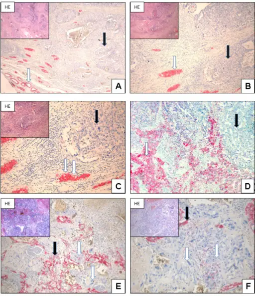 Embryonal Carcinoma