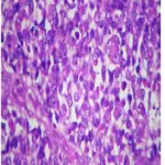 Embryonal Rhabdomyosarcoma