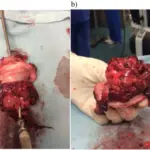 Embryonal Rhabdomyosarcoma of the Vagina