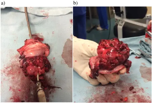 Embryonal Rhabdomyosarcoma of the Vagina