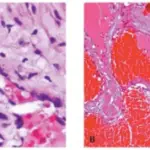 Encapsulated Cavernous Hemangiomas.