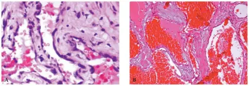 Encapsulated Cavernous Hemangiomas.