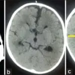 Encephalocele