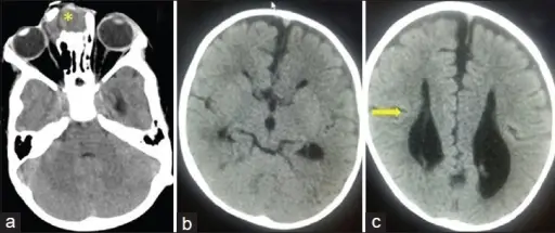 Encephalocele