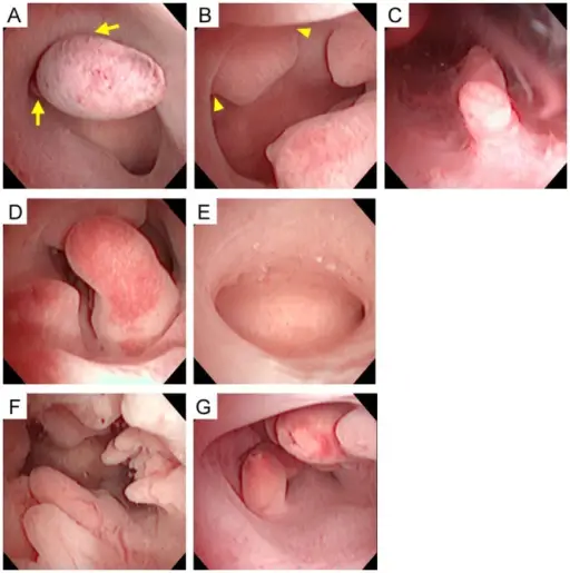 Endometrial Polyps