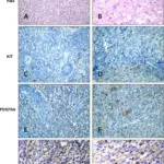 Endometrial Stromal Tumors