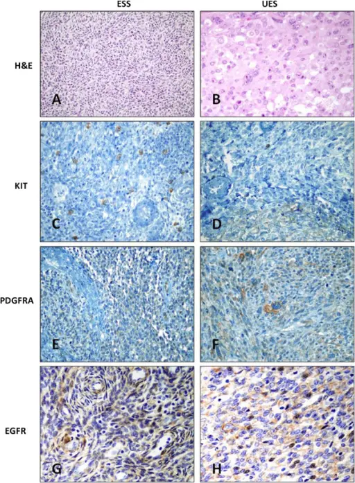 Endometrial Stromal Tumors