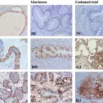 Endometrioid Ovarian Tumors