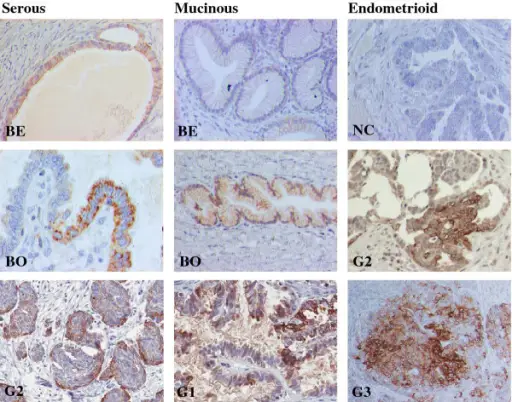 Endometrioid Ovarian Tumors