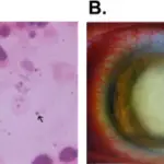 Endophthalmitis