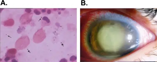 Endophthalmitis