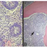 Enteritis Associated Arthritis