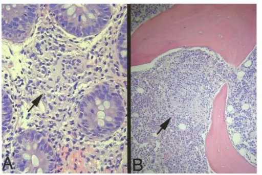 Enteritis Associated Arthritis