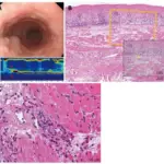 Eosinophilic Esophagitis