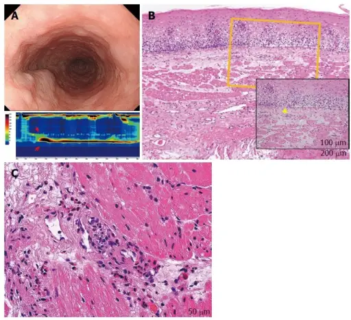 Eosinophilic Esophagitis