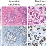 Epithelial Tumors