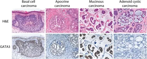 Epithelial Tumors