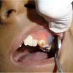 Eruption Cyst