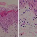 Erythema Multiforme