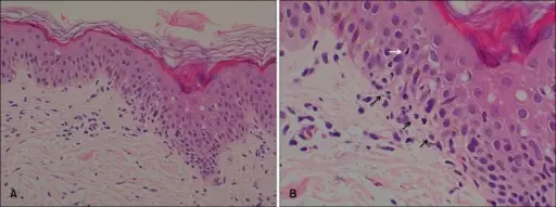 Erythema Multiforme