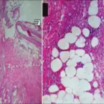 Erythema Nodosum