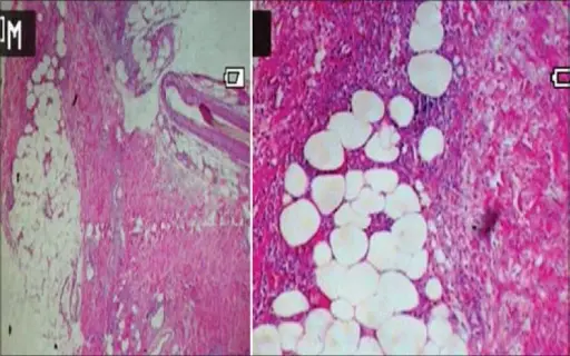 Erythema Nodosum