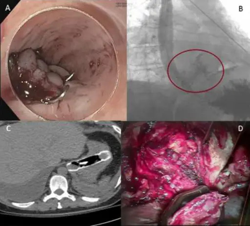 Esophageal Lacerations