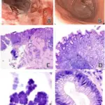 Esophagitis