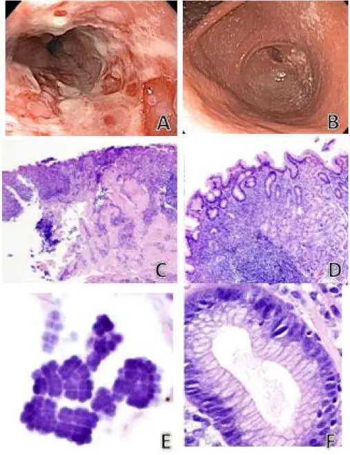 Esophagitis