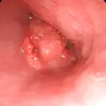 Esophagus Pathology