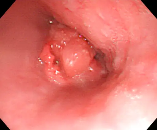 Esophagus Pathology