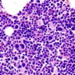 Essential Thrombocythemia