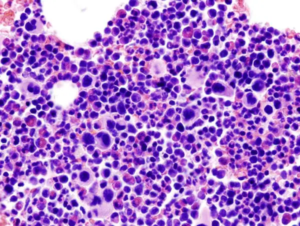 Essential Thrombocythemia