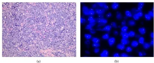 Ewing Sarcoma