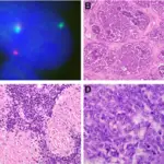 Ewing Sarcoma