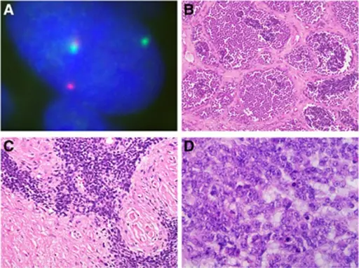 Ewing Sarcoma