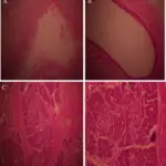 Exocrine Pancreas Pathology