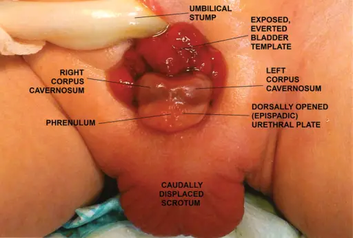 Exstrophy of the Bladder