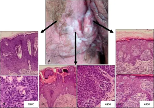 Extramammary Paget Disease of the Vulva