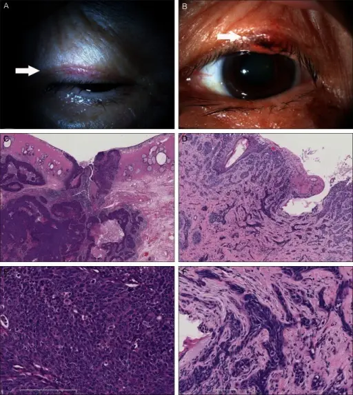 Eyelid Neoplasms