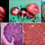 Fallopian Tube Cysts