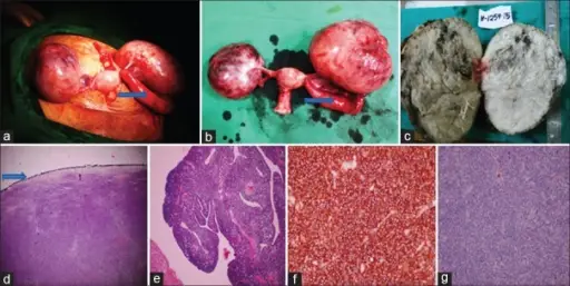 Fallopian Tube Cysts