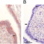 Fallopian Tube Inflammation