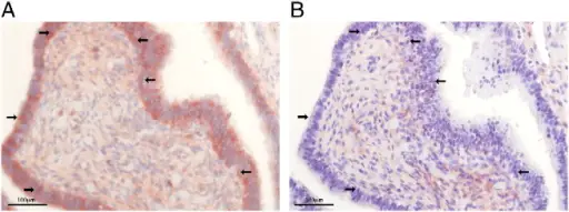 Fallopian Tube Inflammation