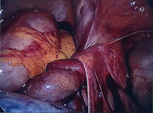 Fallopian Tube Pathology