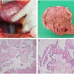 Fallopian Tube Tumors