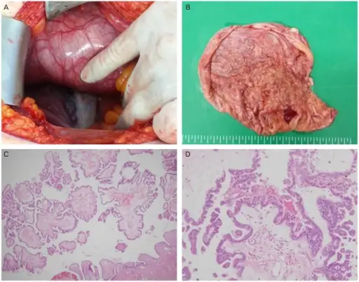 Fallopian Tube Tumors