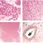 Familial Breast Cancer